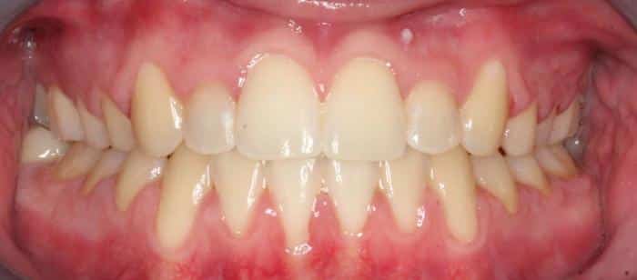 AdultTeen-Anterior-Crossbite-Under-Bite-After.jpg