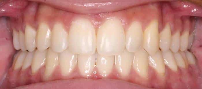 AdultTeen-Crowding-Invisalign-After.jpg