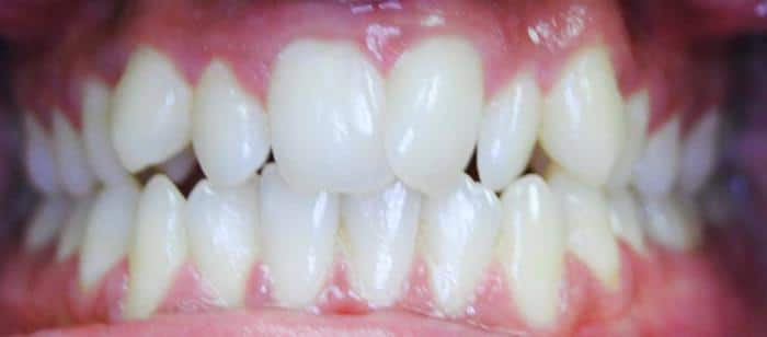 AdultTeen-Crowding-Invisalign-Before.jpg