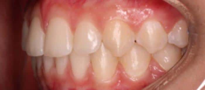 AdultTeen-Flared-Teeth-Invisalign-After.jpg