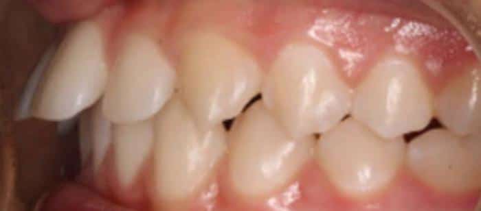 AdultTeen-Flared-Teeth-Invisalign-Before.jpg
