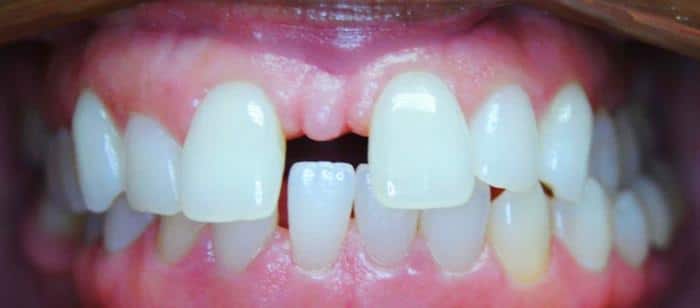 AdultTeen-Spacing-and-Crossbite-Before-1.jpg
