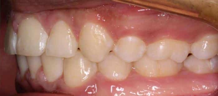 AdultTeen-Tooth-Extractions-After.jpg