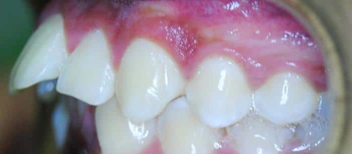 AdultTeen-Tooth-Extractions-Before.jpg