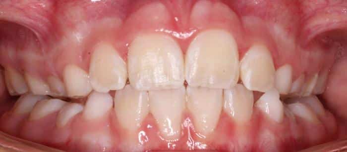 Phase-1-Treatment-on-Children-After.jpg
