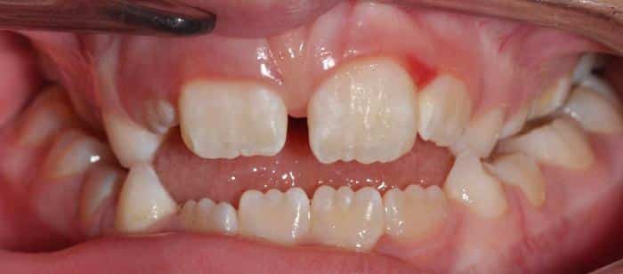 Phase-1-Treatment-on-Children-Before.jpg