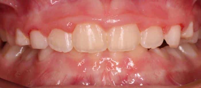 Phase-I-Treatment-on-children-Making-space-for-upper-four-front-teeth-After-1.jpg