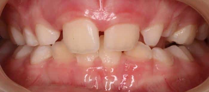 Phase-I-Treatment-on-children-Making-space-for-upper-four-front-teeth-Before.jpg