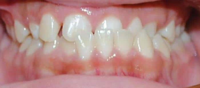 Teen-Anterior-Crossbite-Under-Bite-Before.jpg